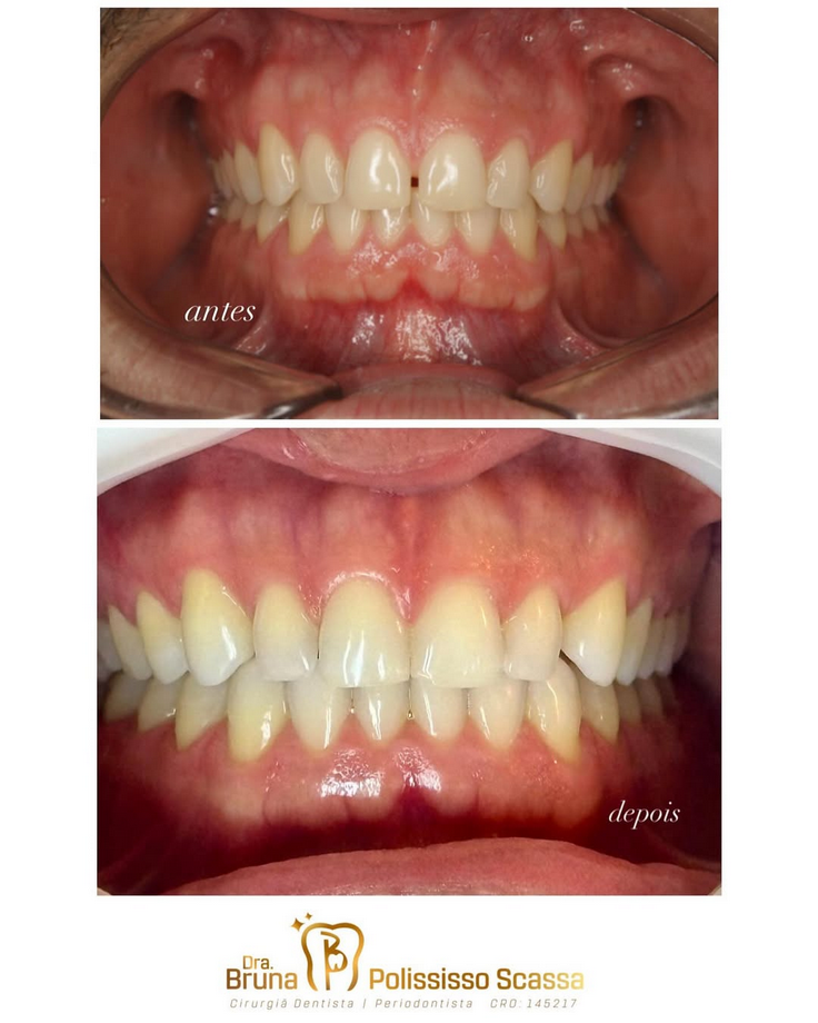 Antes e depois — resultado do tratamento